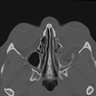 CT FACE WITHOUT CONTRAST