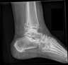 XR ANKLE 3 OR MORE VIEWS (LEFT)