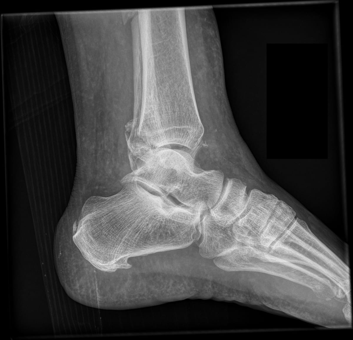 L LAT ANKLE — XR ANKLE 3 OR MORE VIEWS (LEFT)