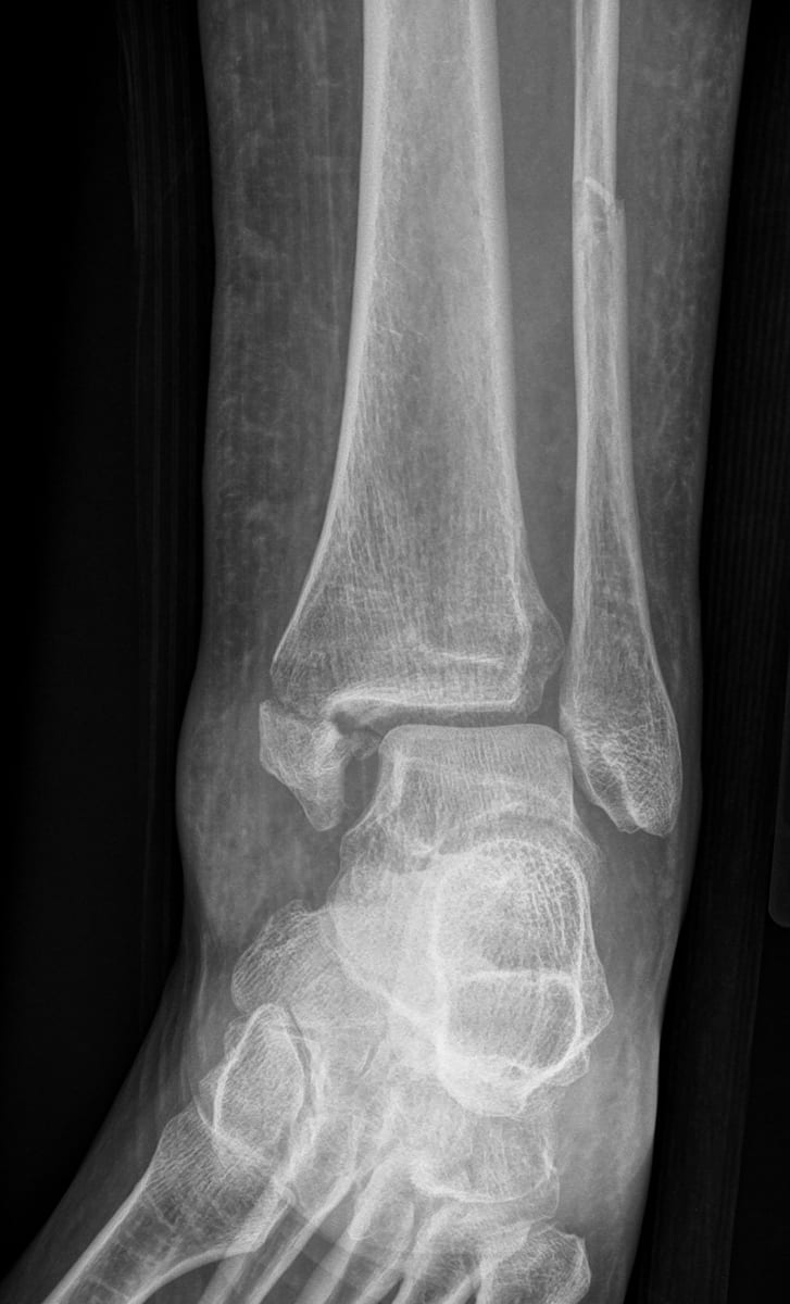 L OBLI ANKLE — XR ANKLE 3 OR MORE VIEWS (LEFT)